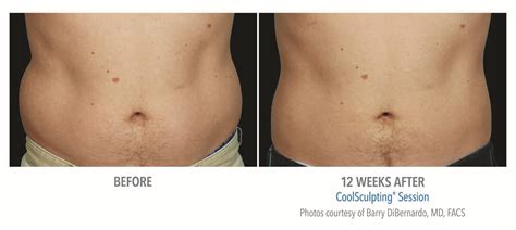 CoolSculpting Results in Atlanta, GA | Sculpted Contours