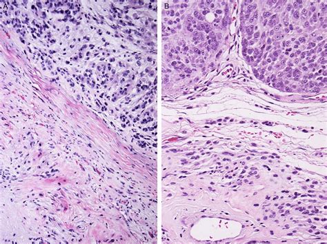 Nine tumors arose in a benign schwannoma (A, conventional schwannoma;... | Download Scientific ...