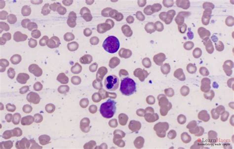 Lymphoma Cells