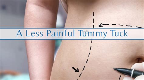 A Less Painful Tummy Tuck - YouTube