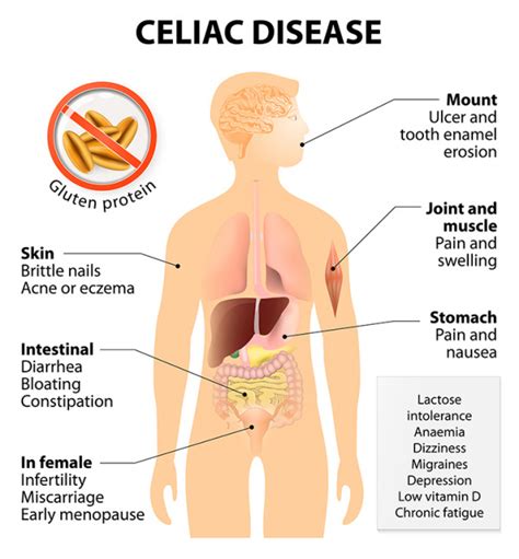 Celiac Disease Symptoms Checklist | Symptoms for Celiac Disease