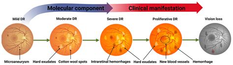 Nonproliferative Vs Proliferative Retinopathy