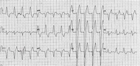 12-Lead ECG case: Elderly man presents with CHF, hypertension and dyspnea