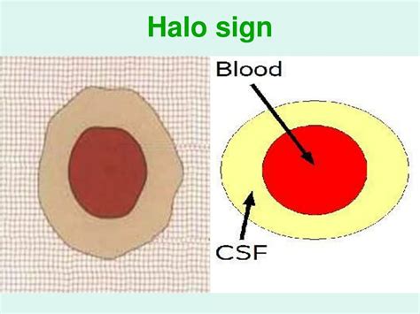 #ICU Nursing #Halo_sign in case... - Mohannad Hamad مهند حمد