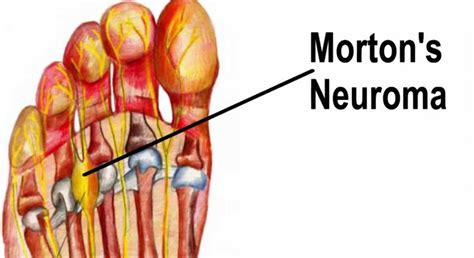 Morton’s Neuroma | Podiatrist Carlsbad | Dr. Keenan Carriero DPM, Encinitas CA