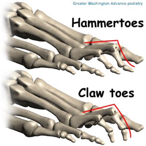 Difference between Hammertoes vs. Claw Toe | Greater Washington ...