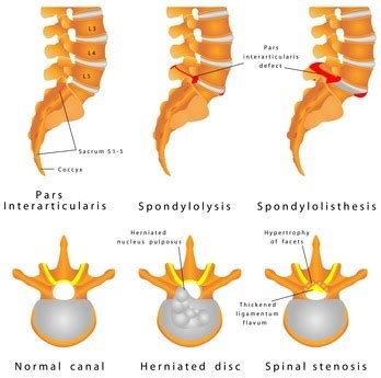 lumbar spondylosis,what to know?