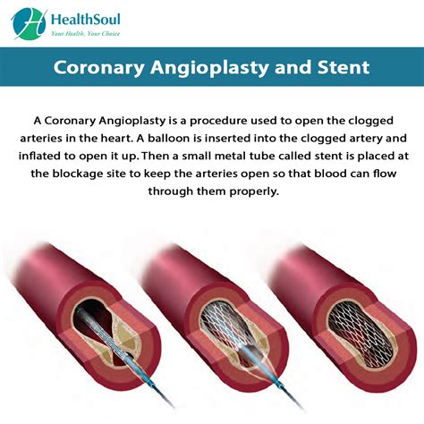 Coronary Angioplasty and Stent – Healthsoul