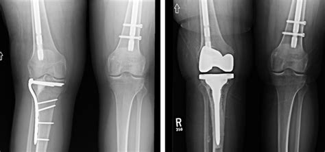 Tibial Plateau Fracture Repair