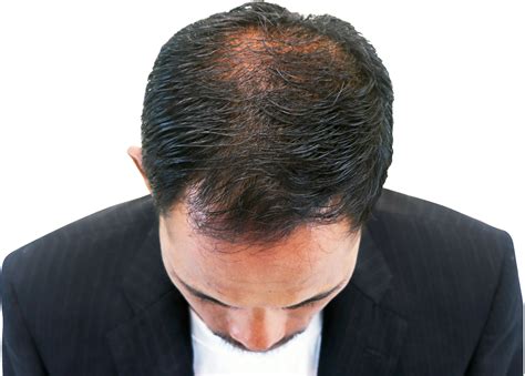 Causes of Hair Loss Atlanta, GA - Hair Restoration Institute of Georgia