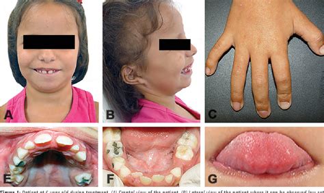 Figure 1 from Orofacial findings and dental care management in a ...