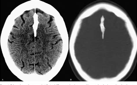 Figure 5 from Falx Cerebri Ossification: CT and MRI Evaluation | Semantic Scholar