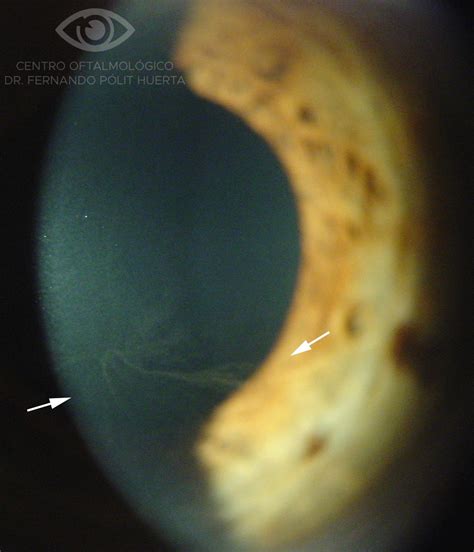 Córnea verticillata - Compendio de imágenes de Oftalmología