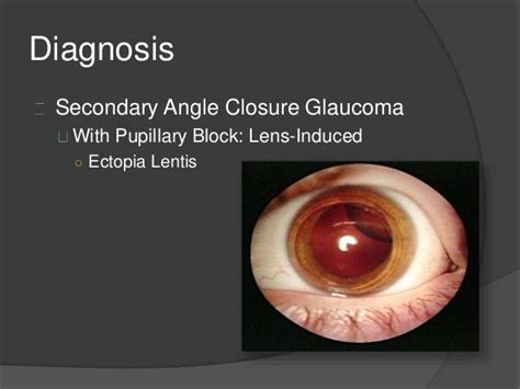 Angle Closure Glaucoma