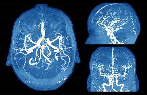 Brain Aneurysm - Miami Vascular Specialists