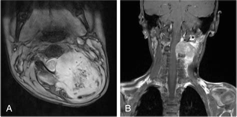 Malignant peripheral nerve sheath tumor in spine: imaging manifestations. | Semantic Scholar