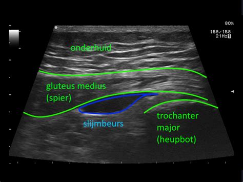 Gluteus Medius Bursitis