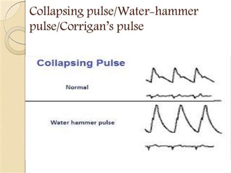 Pulse- Abnormal Findings