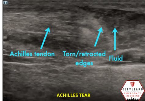 Intern Ultrasound of the Month: Achilles Tendon Rupture — University ...