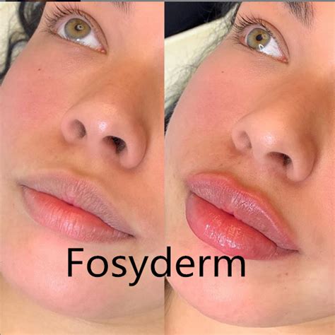 Fosyderm 2ml Lip Enhancement Injectable Dermal Fillers Hyaluronic Acid Gel Injection