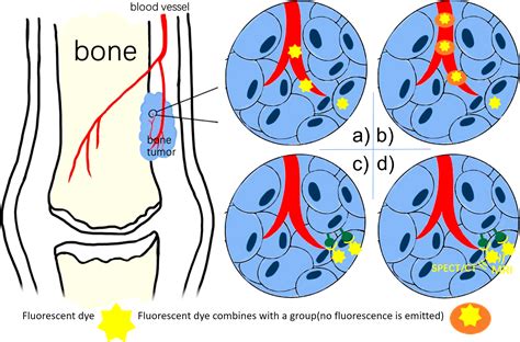 Frontiers | Progresses in Fluorescence Imaging Guidance for Bone and Soft Tissue Sarcoma Surgery