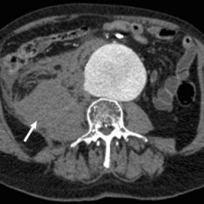 No Survival Benefit Seen for EVAR Over Open Surgery for Ruptured AAA | MDedge Internal Medicine