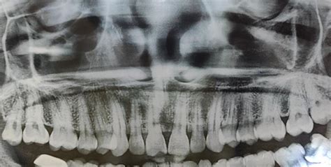 Maxillary Sinus Fracture