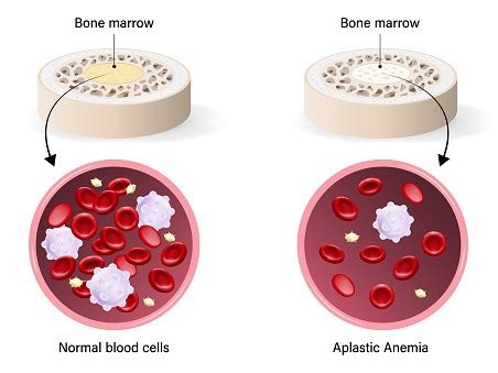 Aplastic Anemia Signs And Symptoms