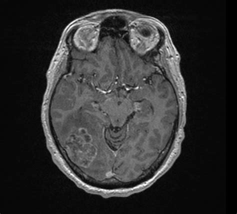 Mri Brain Scan Tumor