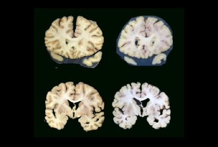 Traumatic brain injury raises risk of brain atrophy | IOS Press