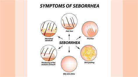 Homeopathic Medicines for Seborrhea Treatment - Doctor Bhatia's Asha Homeopathy