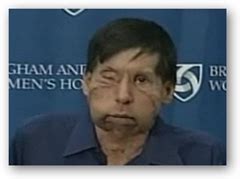 2nd Facial Transplant Patient Makes Public Appearance – Brigham and Woman’s Hospital - Medical Quack