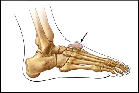 Ganglion Cysts - FootEducation