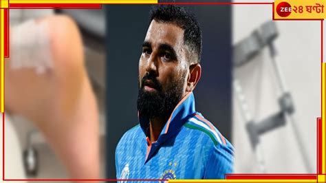 Mohammed Shami Injury Update: গোড়ালিতে সার্জিকাল টেপ, বিছানার পাশে ...