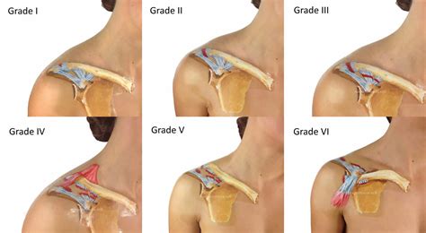 Acromioclavicular joint, acromioclavicular joint injury, separation & osteoarthritis