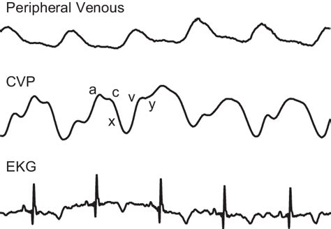 Central Venous Waveform