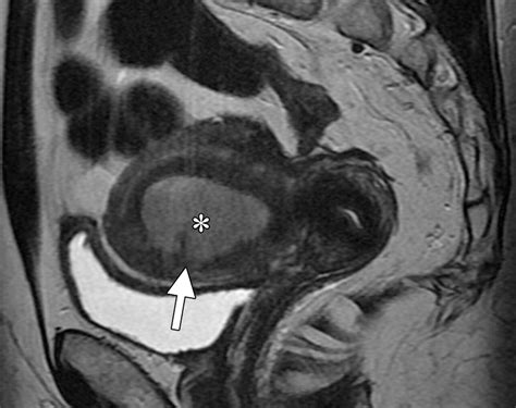 Endometriosis Imaging Mri at Lisa Bean blog