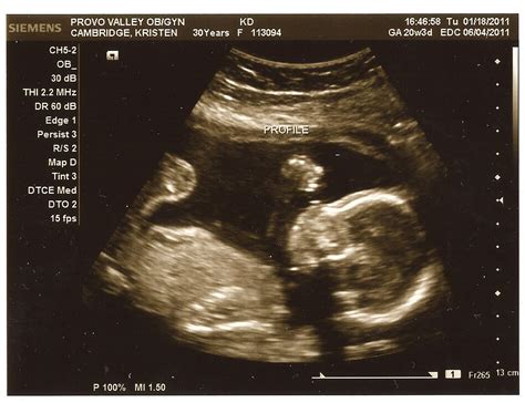 Kristen and Erik: The Ultrasound results are in. We are having a ........