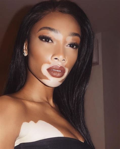 Winnie Harlow Is A Gorgeous Model With Vitiligo - Wow Gallery | Vitiligo cure, Vitiligo ...