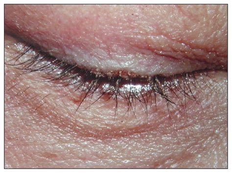 26 New What Causes Eyelash Lice - Demodectic Mange