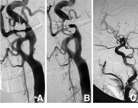 A: Right common carotid angiogram showing an approximately 65% stenosis... | Download Scientific ...