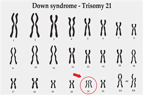 Trisomy 21 - The ObG Project