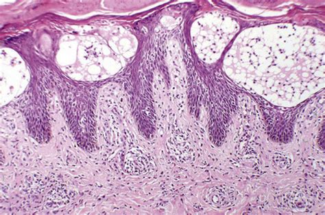 Spongiotic, psoriasiform and pustular dermatoses | Basicmedical Key