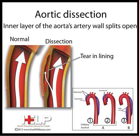 Aortic Dissection | Nursing :) | Pinterest