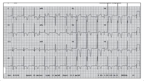 ECG Diagnosis: Apical Hypertrophic Cardiomyopathy | The Permanente Journal