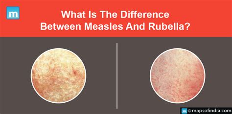 Rubella Rash Vs Measles Rash