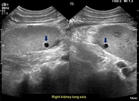 Ultrasound features of Kidney Cysts - Renal Fellow Network