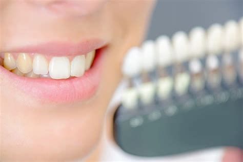 Teeth Stains From Braces - Best Ways To Avoid After Treatment