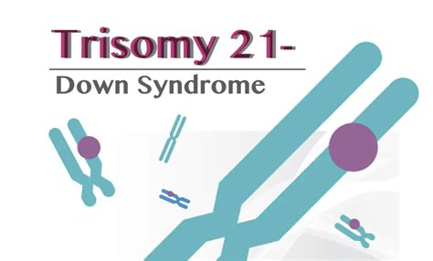 Trisomy 21 (Down Syndrome): Definition, Causes, Symptoms, Pictures and Diagnosis