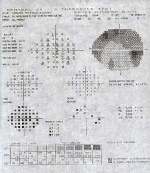 a): Field of vision examination showing bilateral superior arcuate ...